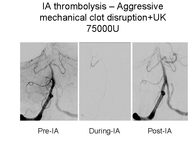 IA thrombolysis – Aggressive mechanical clot disruption+UK 75000 U Pre-IA During-IA Post-IA 