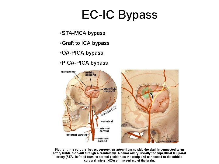 EC-IC Bypass • STA-MCA bypass • Graft to ICA bypass • OA-PICA bypass •