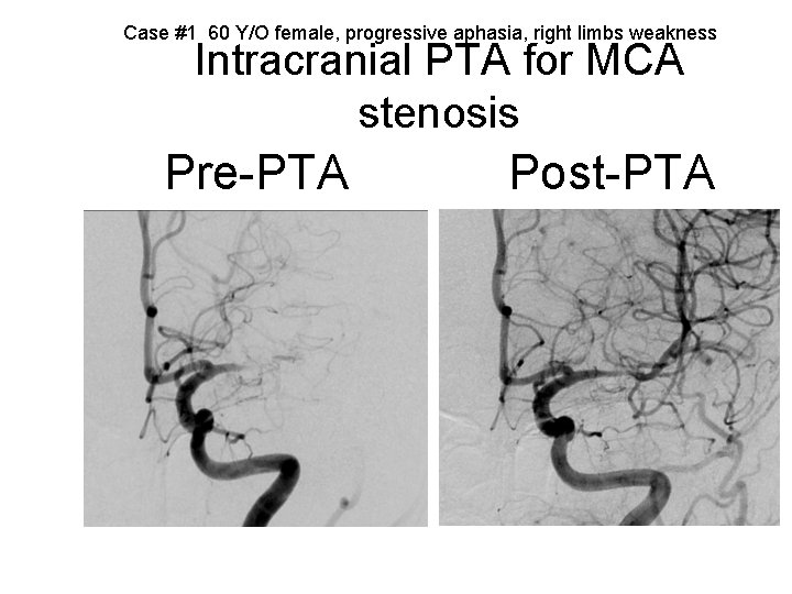 Case #1 60 Y/O female, progressive aphasia, right limbs weakness Intracranial PTA for MCA