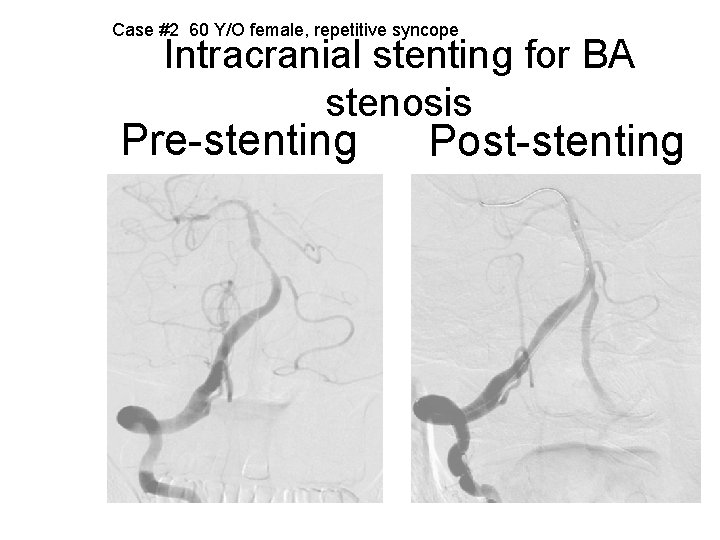 Case #2 60 Y/O female, repetitive syncope Intracranial stenting for BA stenosis Pre-stenting Post-stenting