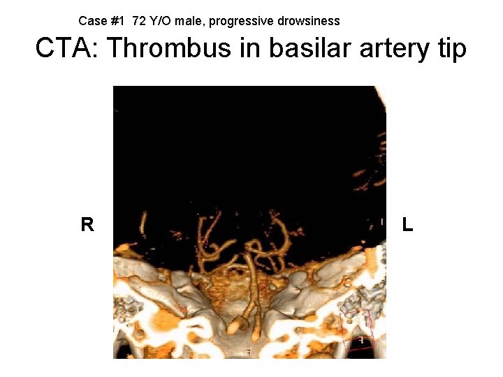 Case #1 72 Y/O male, progressive drowsiness CTA: Thrombus in basilar artery tip R