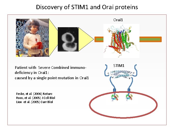 Discovery of STIM 1 and Orai proteins Orai 1 Patient with Severe Combined immunodeficiency