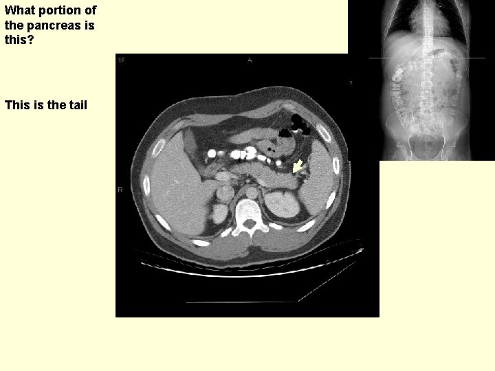 What portion of the pancreas is this? This is the tail 