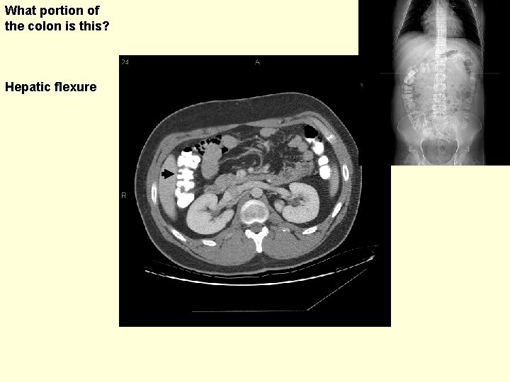 What portion of the colon is this? Hepatic flexure 