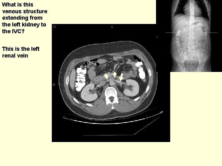 What is this venous structure extending from the left kidney to the IVC? This