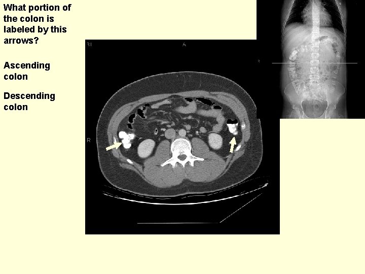 What portion of the colon is labeled by this arrows? Ascending colon Descending colon