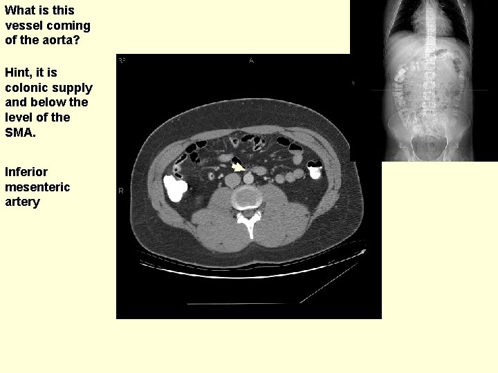 What is this vessel coming of the aorta? Hint, it is colonic supply and