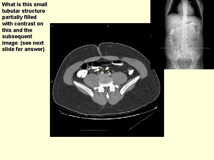 What is this small tubular structure partially filled with contrast on this and the