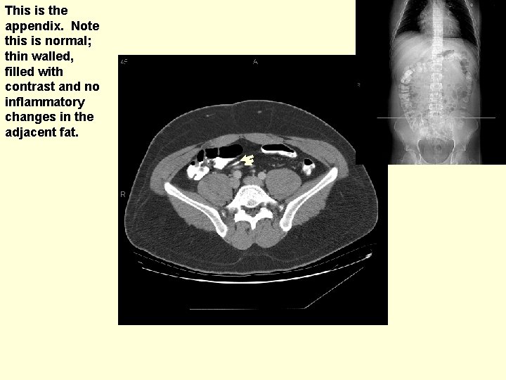 This is the appendix. Note this is normal; thin walled, filled with contrast and