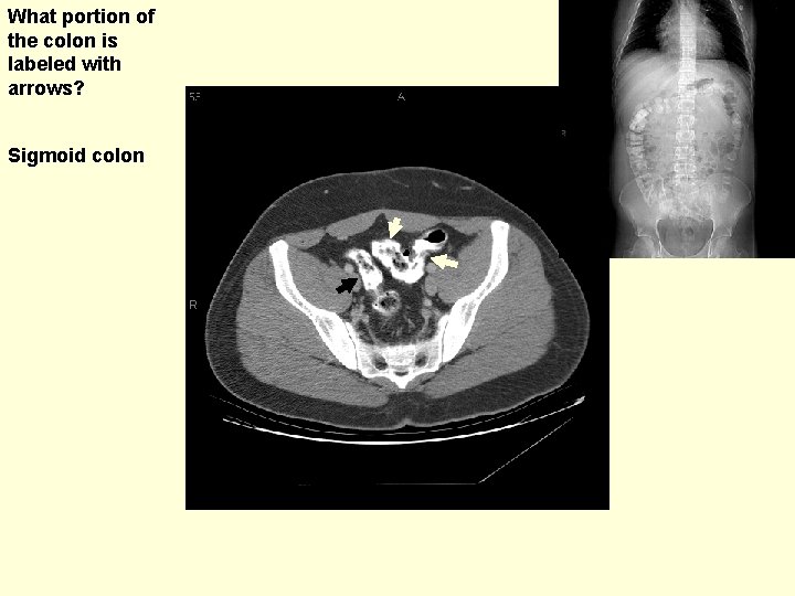 What portion of the colon is labeled with arrows? Sigmoid colon 