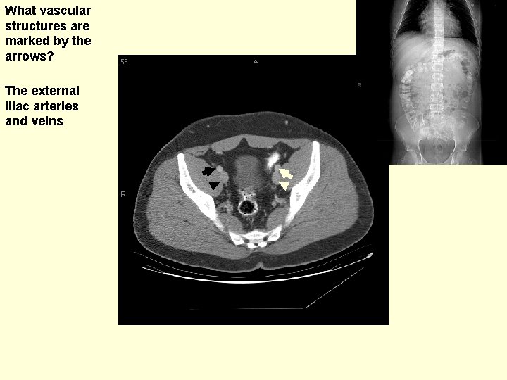 What vascular structures are marked by the arrows? The external iliac arteries and veins