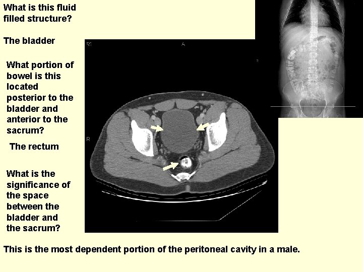 What is this fluid filled structure? The bladder What portion of bowel is this