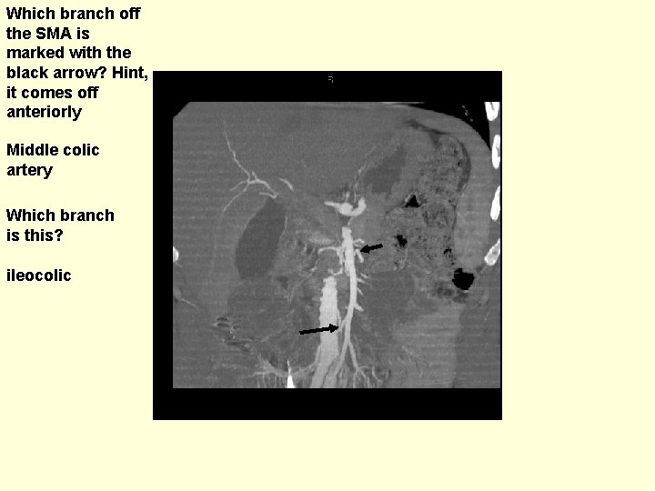 Which branch off the SMA is marked with the black arrow? Hint, it comes