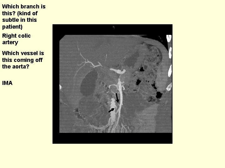 Which branch is this? (kind of subtle in this patient) Right colic artery Which