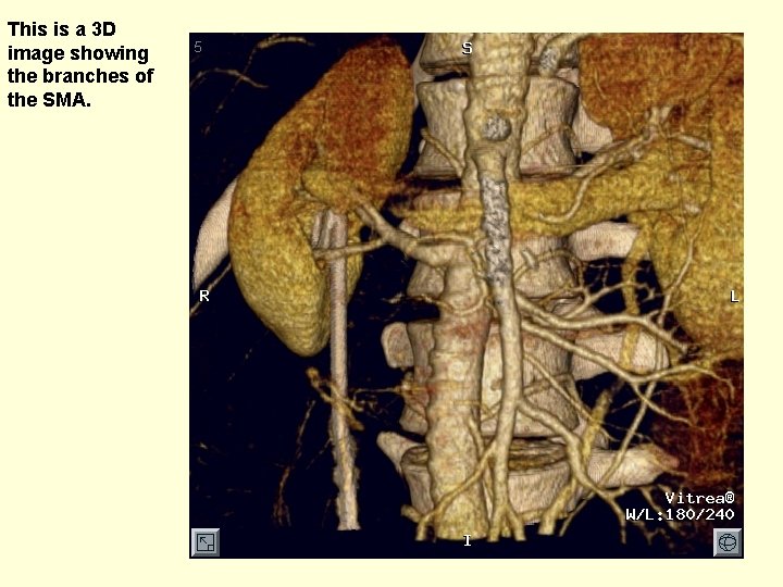 This is a 3 D image showing the branches of the SMA. 