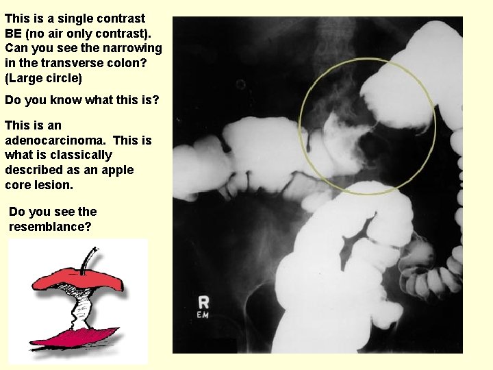 This is a single contrast BE (no air only contrast). Can you see the