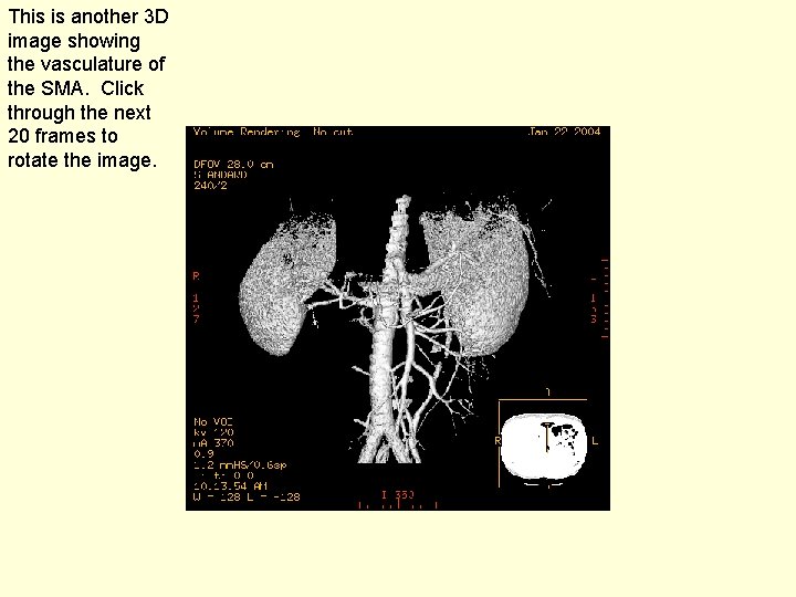 This is another 3 D image showing the vasculature of the SMA. Click through