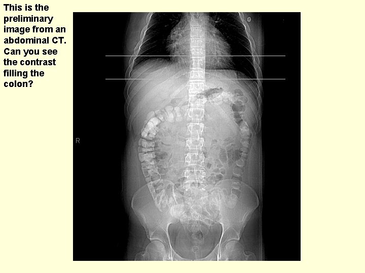 This is the preliminary image from an abdominal CT. Can you see the contrast