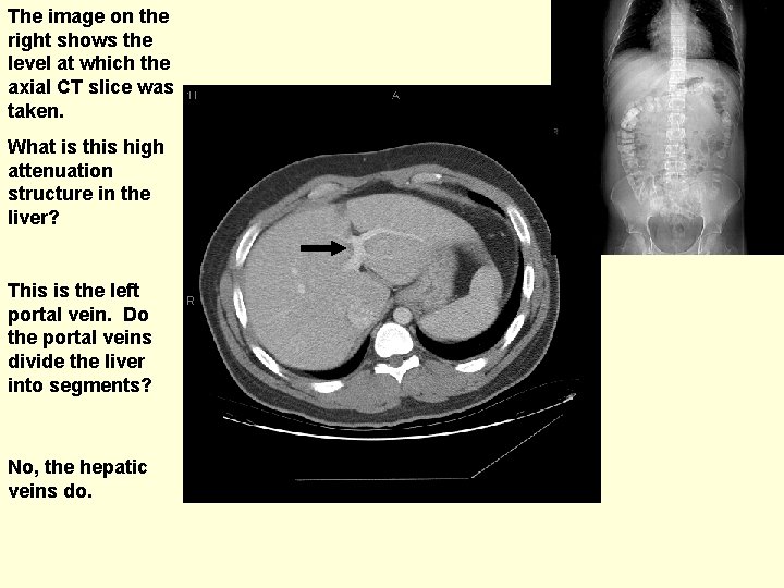 The image on the right shows the level at which the axial CT slice