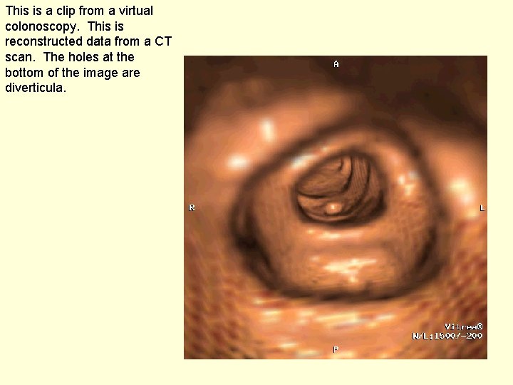 This is a clip from a virtual colonoscopy. This is reconstructed data from a