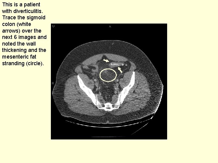 This is a patient with diverticulitis. Trace the sigmoid colon (white arrows) over the