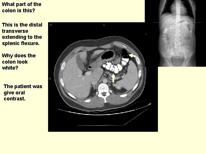 What part of the colon is this? This is the distal transverse extending to