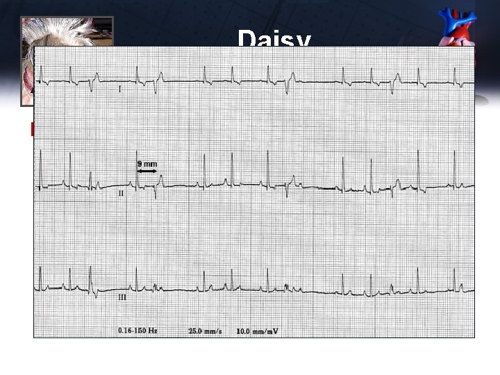 Daisy ECG 