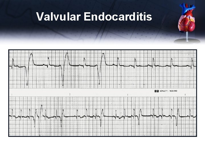 Valvular Endocarditis ECG abnormalities • Tall, wide P wave (LA enlargement) • Tall R