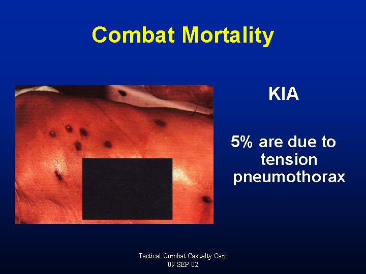 Combat Mortality KIA 5% are due to tension pneumothorax Tactical Combat Casualty Care 09
