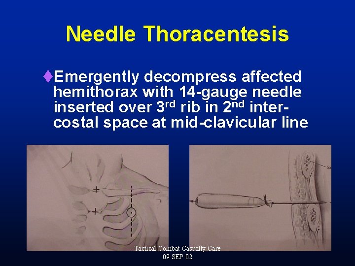 Needle Thoracentesis t. Emergently decompress affected hemithorax with 14 -gauge needle inserted over 3