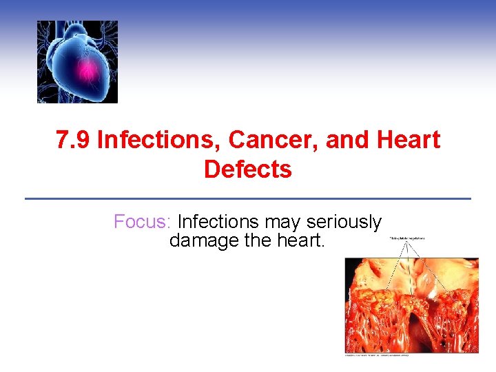 7. 9 Infections, Cancer, and Heart Defects Focus: Infections may seriously damage the heart.