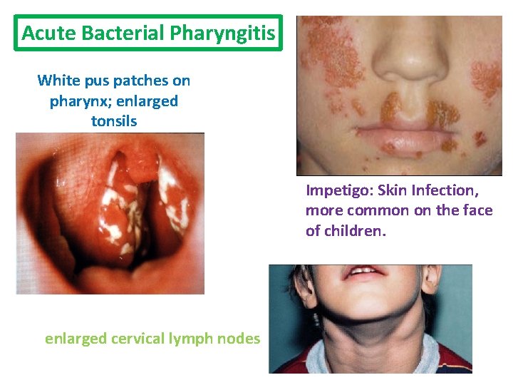 Acute Bacterial Pharyngitis White pus patches on pharynx; enlarged tonsils Impetigo: Skin Infection, more