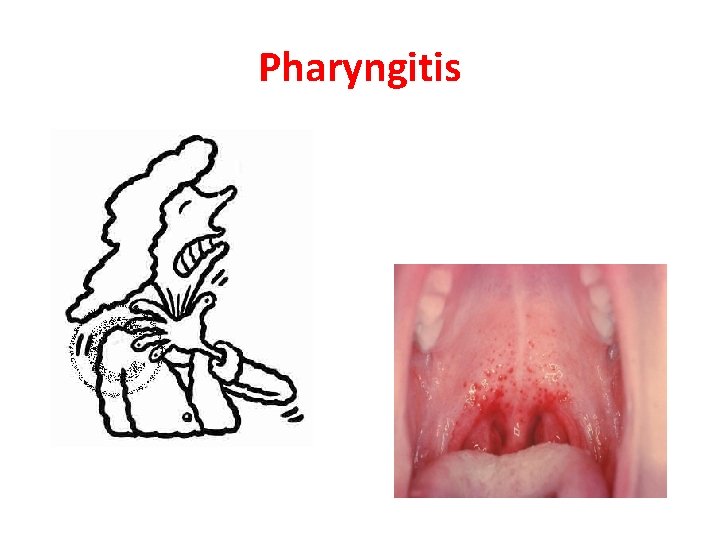 Pharyngitis 