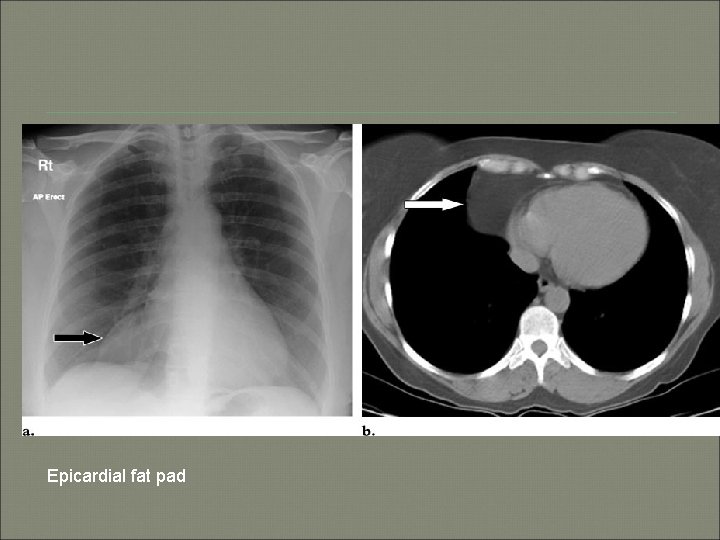 Epicardial fat pad 