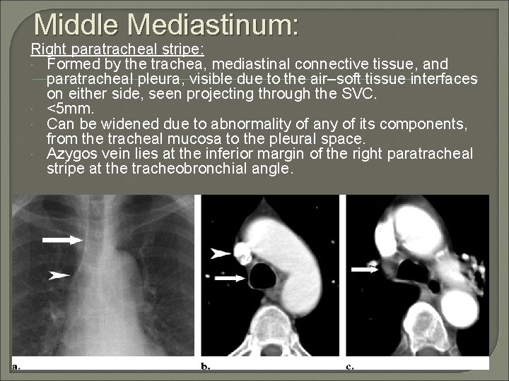 Middle Mediastinum: Right paratracheal stripe: Formed by the trachea, mediastinal connective tissue, and paratracheal