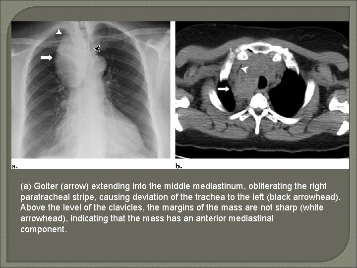 (a) Goiter (arrow) extending into the middle mediastinum, obliterating the right paratracheal stripe, causing
