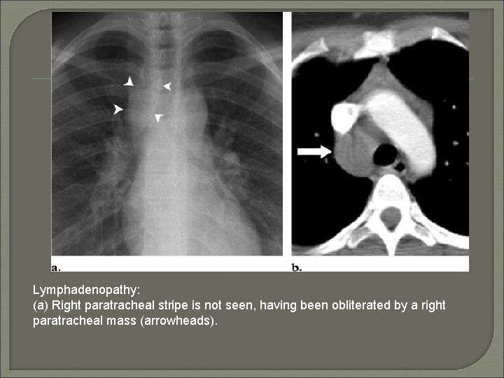 Lymphadenopathy: (a) Right paratracheal stripe is not seen, having been obliterated by a right