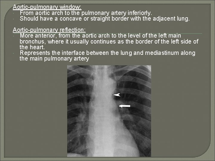 Aortic-pulmonary window: From aortic arch to the pulmonary artery inferiorly. Should have a concave