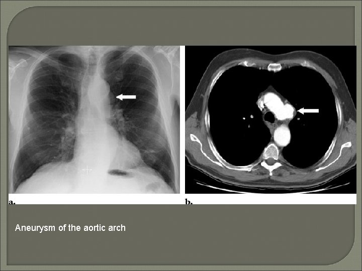 Aneurysm of the aortic arch 