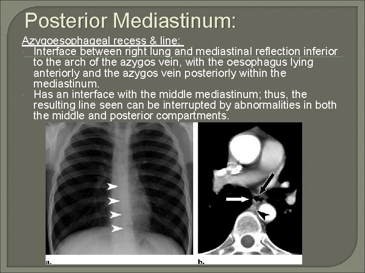 Posterior Mediastinum: Azygoesophageal recess & line: Interface between right lung and mediastinal reflection inferior