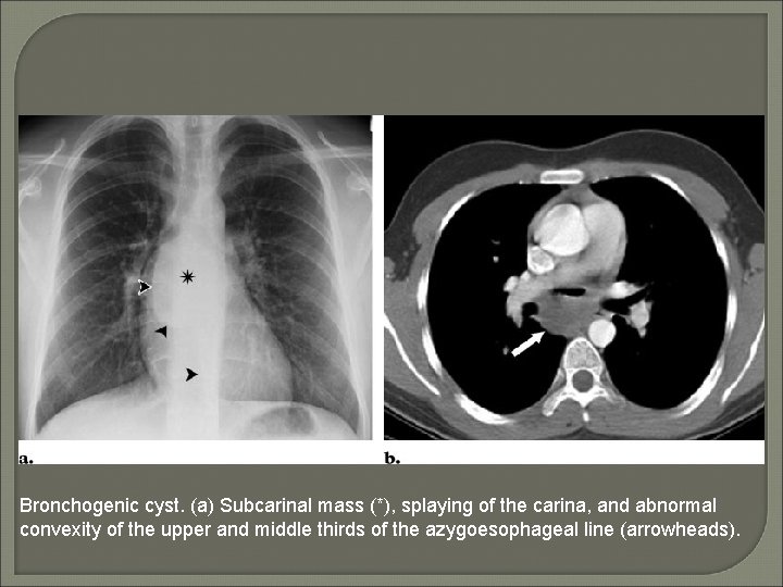 Bronchogenic cyst. (a) Subcarinal mass (*), splaying of the carina, and abnormal convexity of