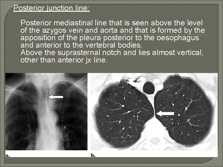 Posterior junction line: Posterior mediastinal line that is seen above the level of the