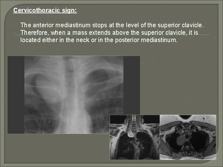 Cervicothoracic sign: The anterior mediastinum stops at the level of the superior clavicle. Therefore,