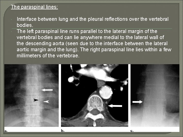 The paraspinal lines: Interface between lung and the pleural reflections over the vertebral bodies.