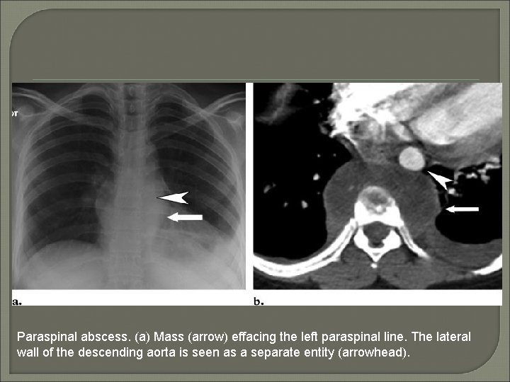 Paraspinal abscess. (a) Mass (arrow) effacing the left paraspinal line. The lateral wall of