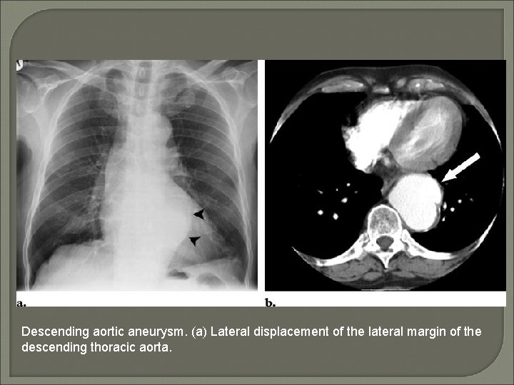 Descending aortic aneurysm. (a) Lateral displacement of the lateral margin of the descending thoracic