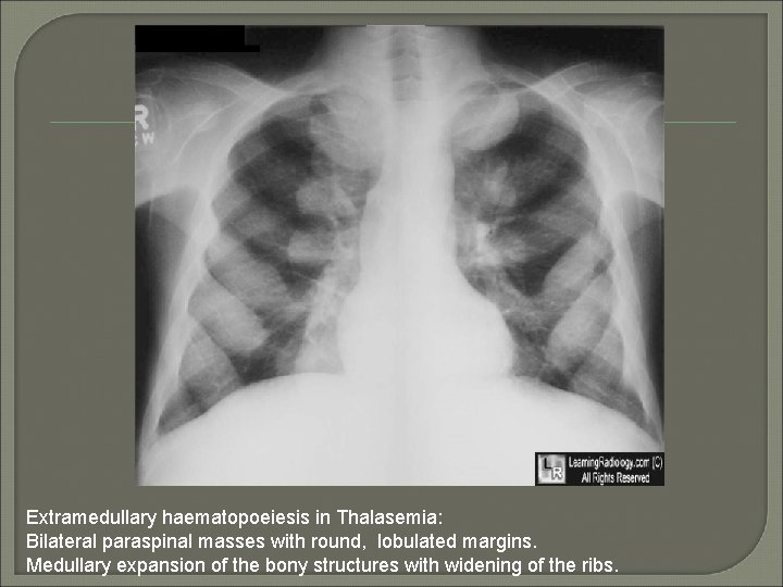 Extramedullary haematopoeiesis in Thalasemia: Bilateral paraspinal masses with round, lobulated margins. Medullary expansion of