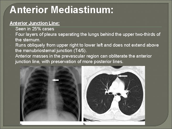 Anterior Mediastinum: Anterior Junction Line: Seen in 25% cases Four layers of pleura separating