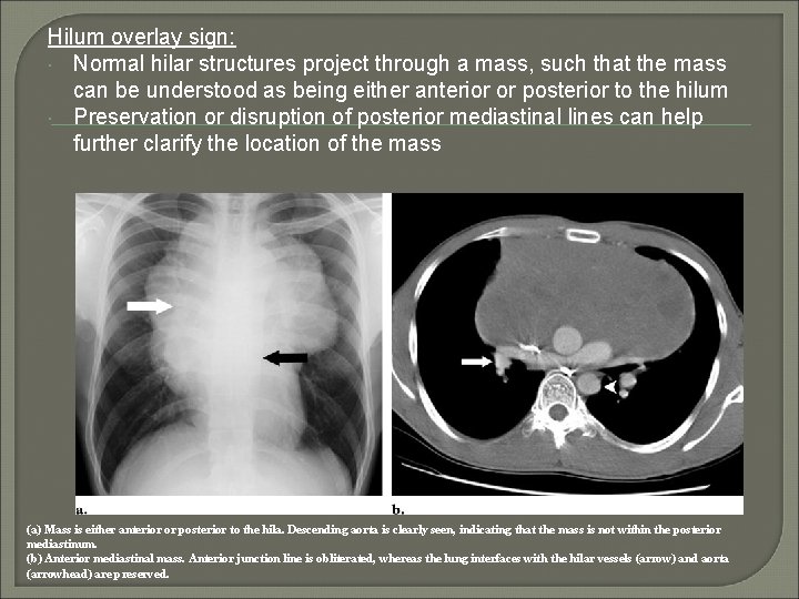 Hilum overlay sign: Normal hilar structures project through a mass, such that the mass