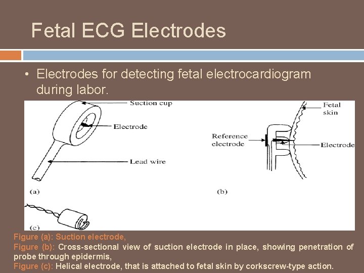 Fetal ECG Electrodes • Electrodes for detecting fetal electrocardiogram during labor. Figure (a): Suction
